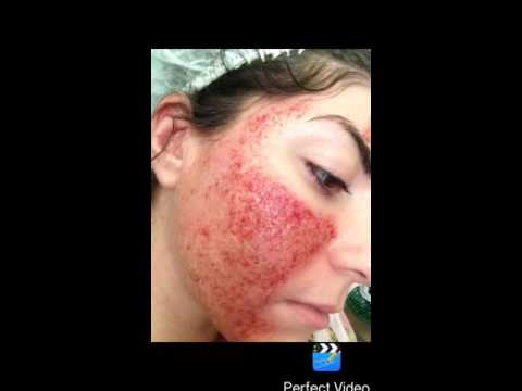 Самое эффективное отбеливание кожи Как избавится от веснушек парню