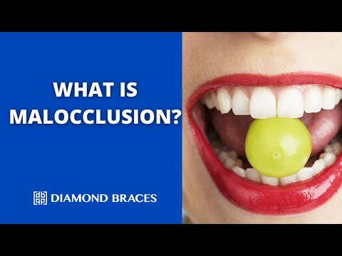 Malocclusion: Understanding Misaligned Bites and Their Treatment