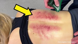 Scoliosis 😳 Purple Marks Come From Her Skin! *Cracks & Deep Tissue* Work Bring Healing! 