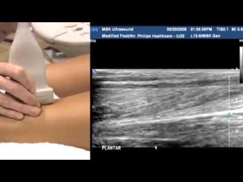 Ultrasound of the Foot and Ankle