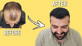 Hair Transplant in Turkey | 5200 Grafts | Before and After 12 MONTHS-- UPDATE