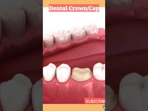 Dental Crown 👑 or Cap 🧢 Procedure #dentistry #dentalcare #animation