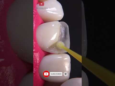 Awesome broken tooth restoration