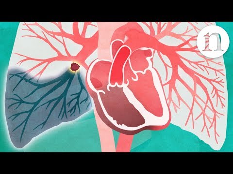 image-What is the difference between an embolus and a clot?