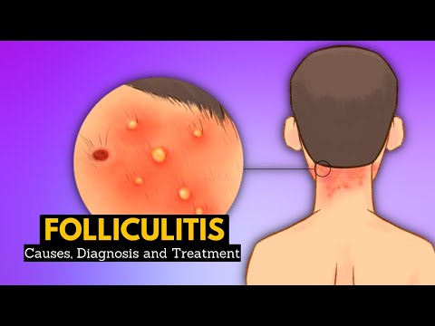 Sunburn Causes Signs and Symptoms Diagnosis and Treatment