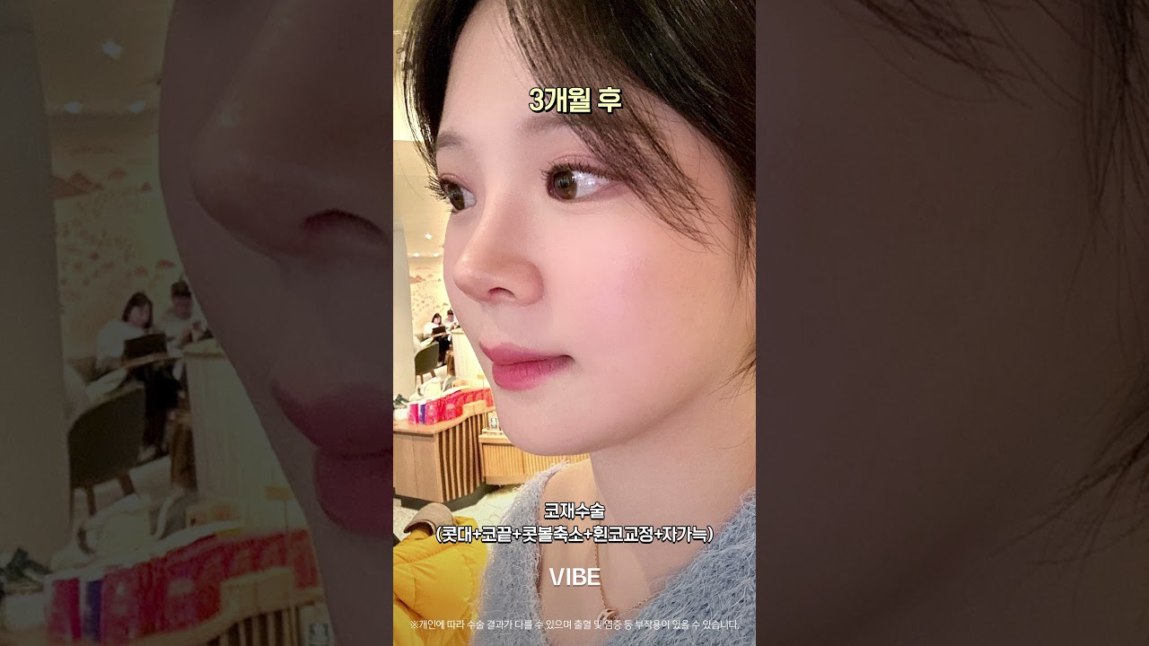 코재수술(콧대+코끝+콧볼축소+휜코교정+자가늑)