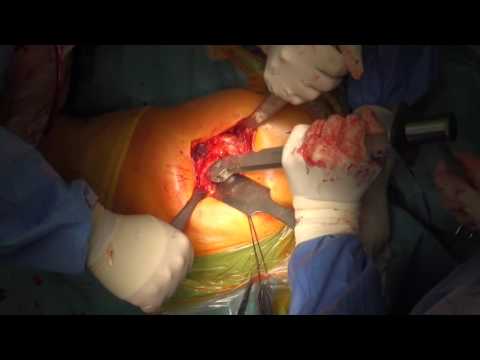 Malattia in cui colpi di scena articolazioni Osteocondrosi del collo e delle sue conseguenze