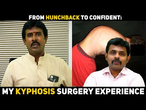 Kyphosis Surgery Success Story - patient testimonial