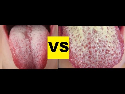 Paa halamang-singaw ng kati ng sakong Sakit sa balat Fungus sa paa