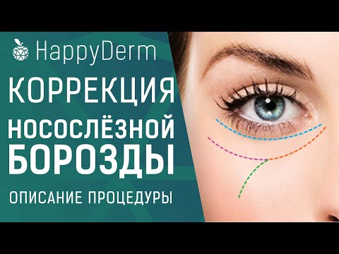 Коррекция носослёзной борозды. Как убрать мешки под глазами без операции.