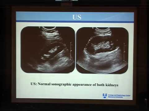 UNC VIDEOS Diagnosis of Upper Urinary Tract Obstruction Prof/ Ahmed A. Shokeir