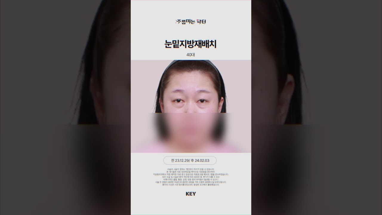 40대의 눈밑지방재배치 대구키성형외과
