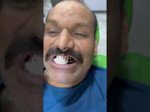 Teeth whitening powder #dentist  #dentaltreatment  #foreigntraineddentist  #doctor  #doctor