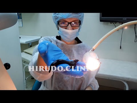 Anti-Aging Blood Detox with Medicinal Leeches Hirudotherapy | Hirudo.Clinic #antiaging treatment