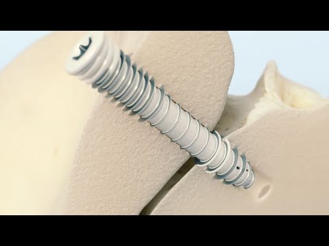 TransLoc 3D™ Patient Animation