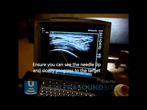 Ultrasound Guided Subacromial Bursal injection