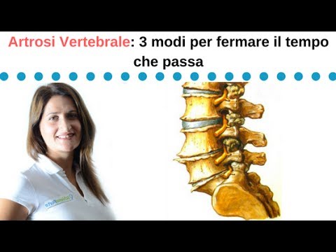 Articolazioni della mano che analizza Il motivo per cui vè una colonna vertebrale cervicale fissatore