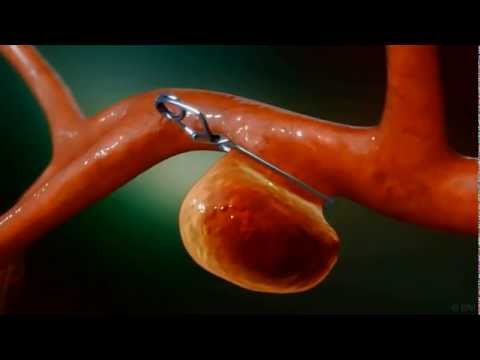 Aneurysm Clipping Surgery - Animation