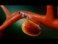 Aneurysm Clipping Surgery Animation