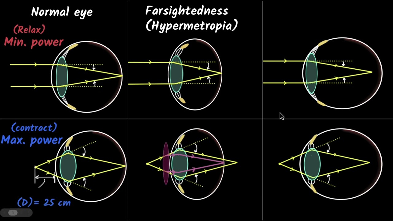 Defects of vision | The human eye and the colourful world | Physics class 10 | Khan Academy