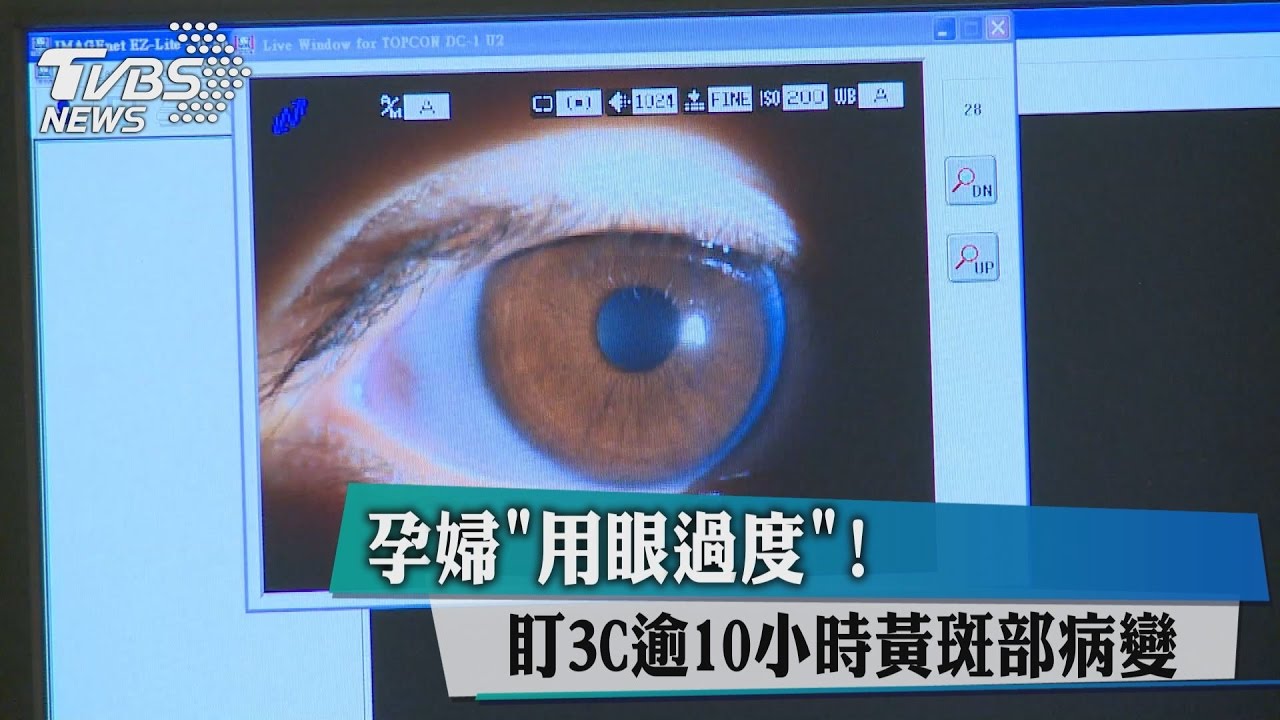 孕婦用眼過度 盯3C逾10小時黃斑部病變