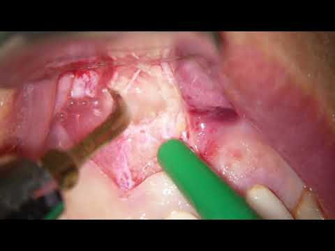 Удаление кисты: апикальная  микрохирургия с пьезоэлектрическим аппаратом