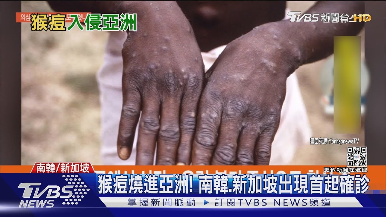 猴痘燒進亞洲! 南韓、新加坡出現首起確診