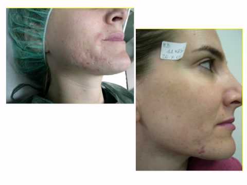 Come carbonato di sodio per togliere lentiggini Che fare contro pigmentary nota su una faccia