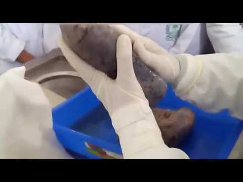 Lungs Anatomy ( Features, Side Determination and Anatomical Points)