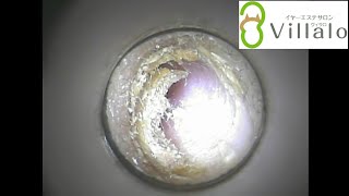 耳掃除動画vol.47「硬めの耳垢」