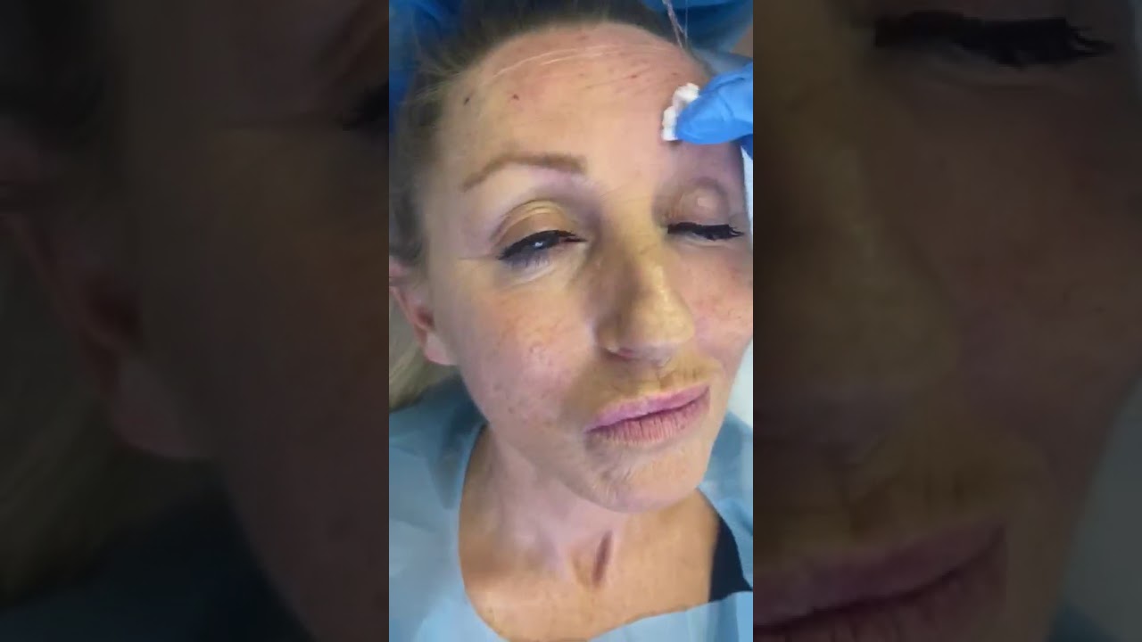 Training Face lift PDO 2 - Professional Aesthetics Academy