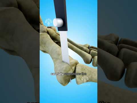 How Bunion Surgery Can Transform Your Foot Health 😲 #shorts #viralvideo - Creativelearning3d