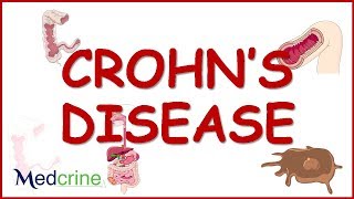 pathophysiology of crohns disease