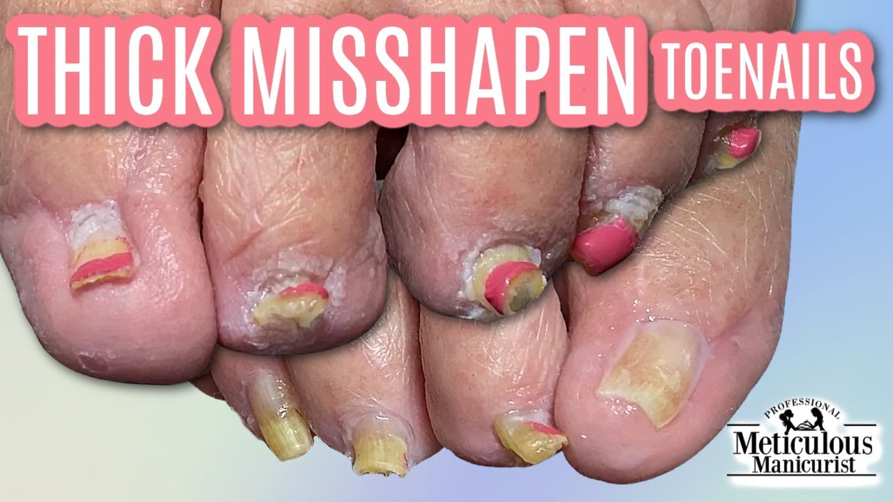 👣How to Cut Thick Curving Misshapen Elderly Toenails👣