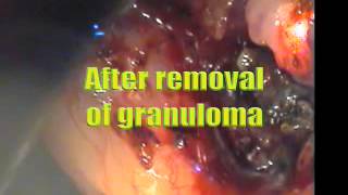 Laryngeal foreign body