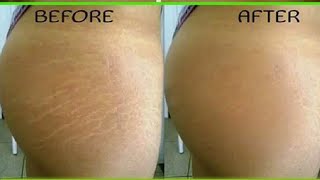 Get Rid Of Stretch Marks In 7 Days.