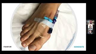 USGPIVC in Difficult Venous Access