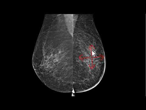 Alterações na mamografia após o tratamento conservador do câncer de mama
