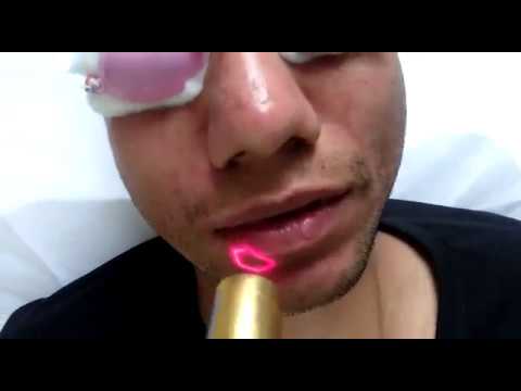 Acne Scar Treatment