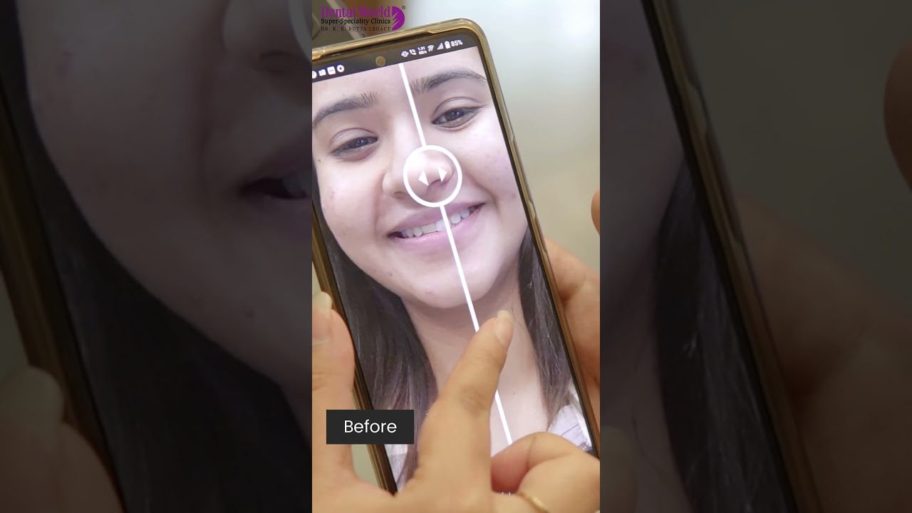 The Smile App by Invisalign - A step by step tutorial