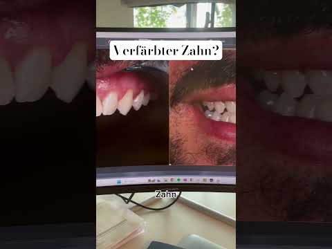 Kein Problem dank FLOWABLE INJECTION 💁🏼‍♂️ #flowableinjection #veneers #zahnarzt #schönezähne