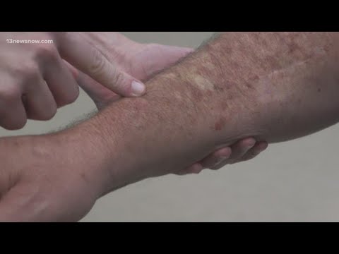 Skin Cancer: How to spot melanoma warning signs