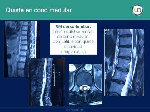 Quiste del cono medular