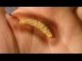 Mouth Popping; Salivary Stone Removed - Cysts.