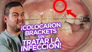 ¡BRACKETS!: Ortodoncia con DIENTES con ENDODONCIA (TRATAMIENTOS DE CONDUCTO) ¿SE PUEDE ¡CASO REAL!