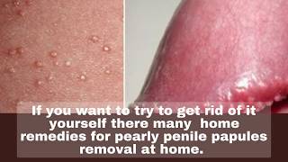 How To Get Rid Of PPP in 3 Days  | Pearly Papules Removal Easy and Quickly
