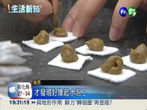 三伏貼治過敏鼻炎 非人人適用