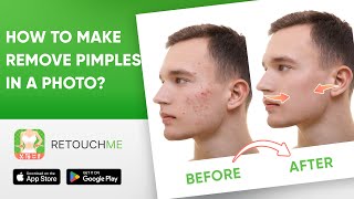From Acne to Clear Skin: Get Rid of Pimples in Your Photos with RetouchMe Photo Editor