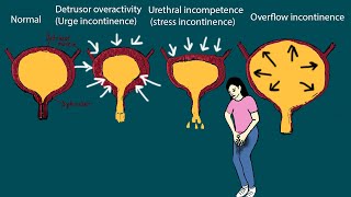 Urinary Incontinence - Why Can