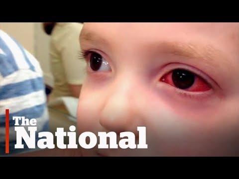 Antibiotics may not be the answer to pink eye
